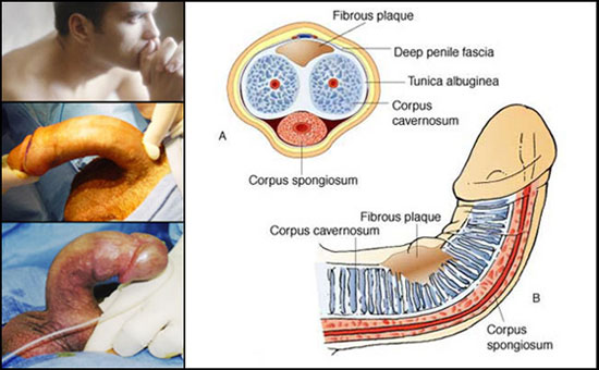 Peyronie's Disease